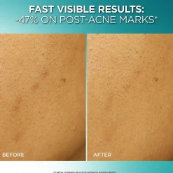 Dark Spot Exfoliant Peel for Reducing Dark Spots & Brightening Skin